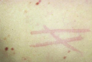 Dermatografismo