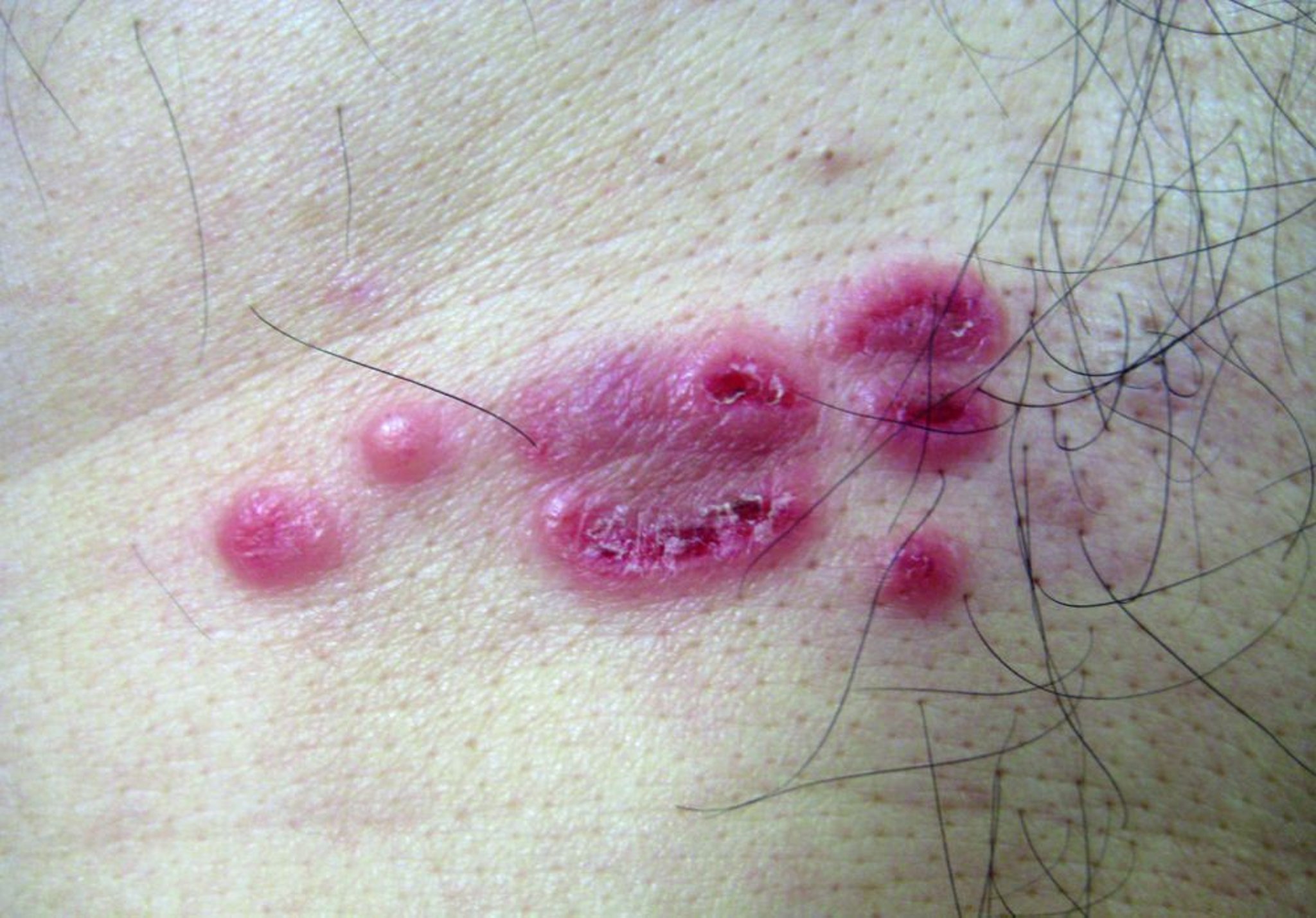 Leukemia Cutis (Localized)