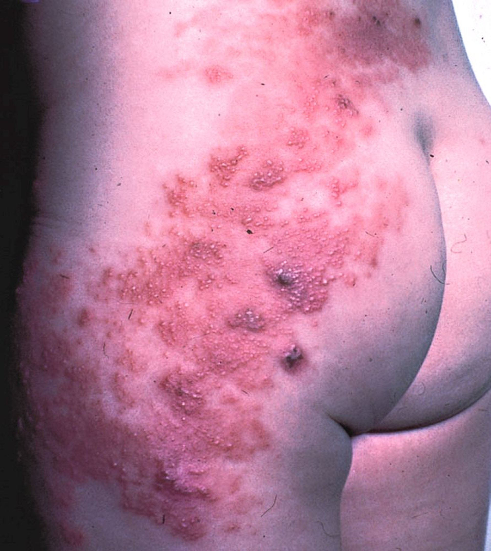 Herpes zoster (lumbales Dermatom)