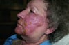Herpes zóster (distribución del nervio trigémino V2 y V3)