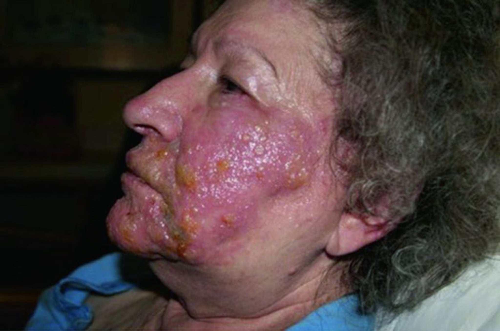 Herpes zóster (distribución del nervio trigémino V2 y V3)