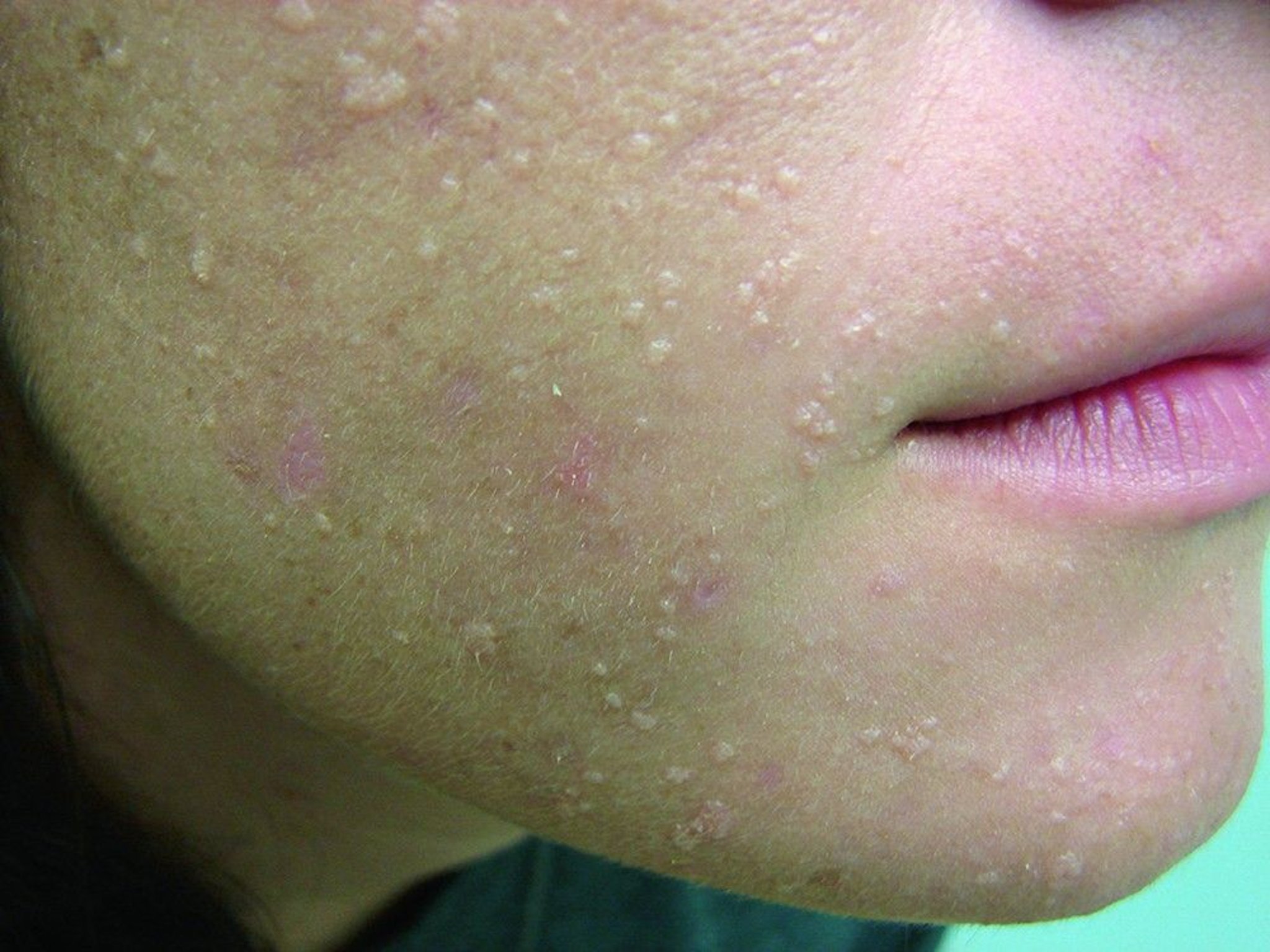 Flat Warts
