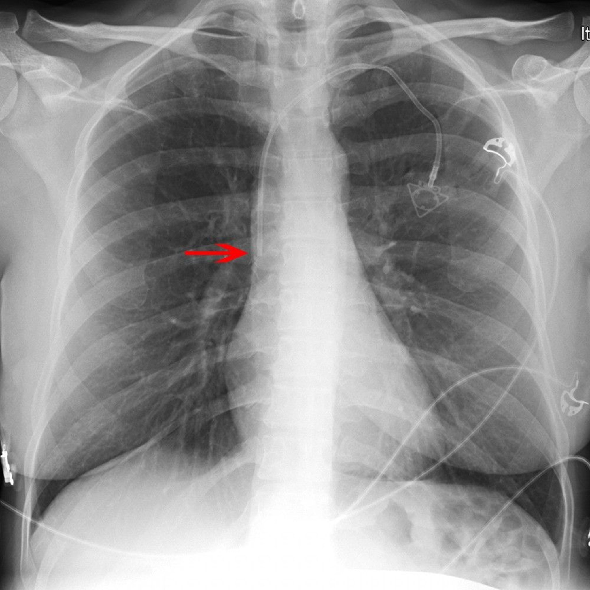 Radiograph of a Central Venous Catheter