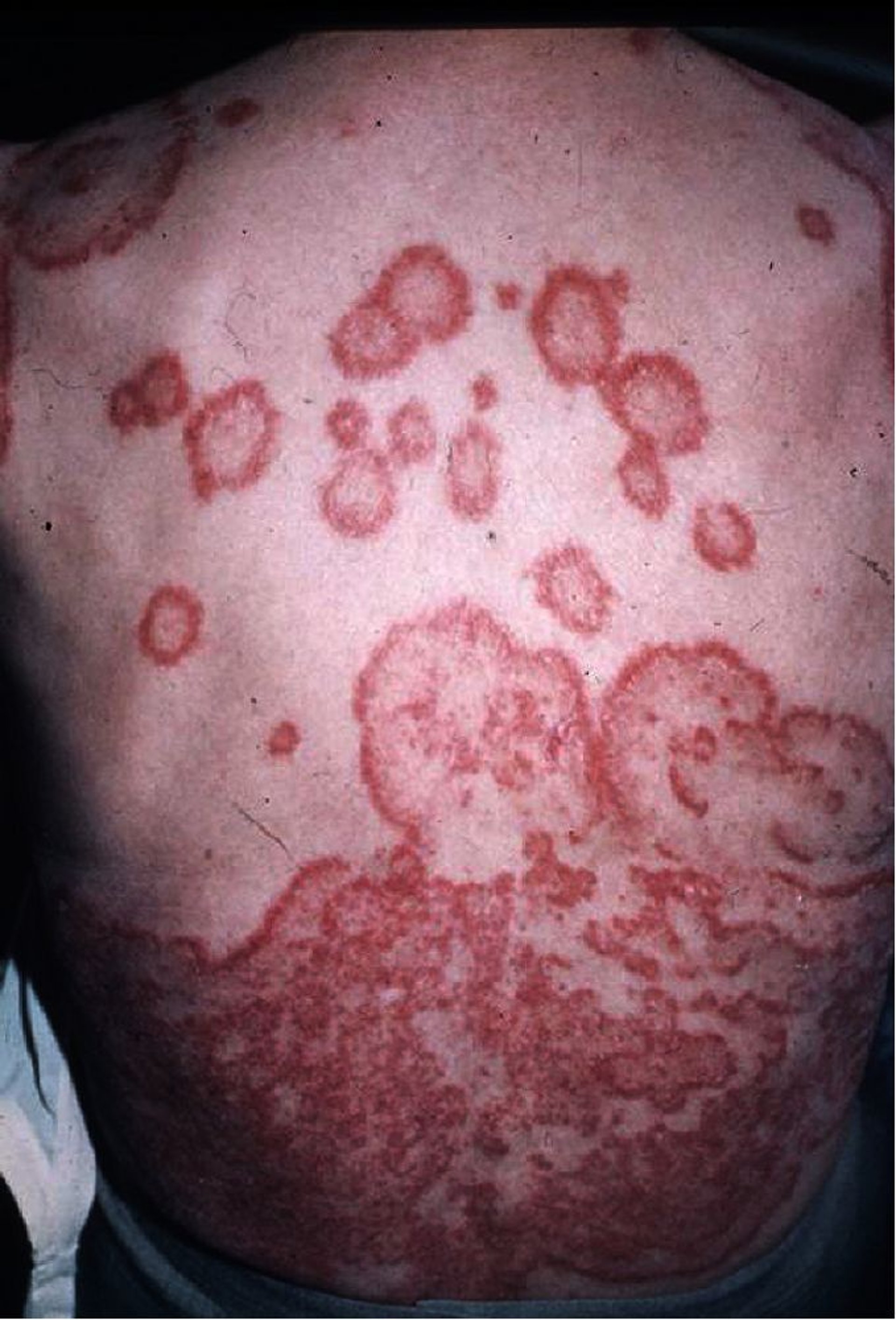 Erythema gyratum repens