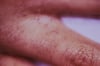 Scabbia classica