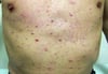 Leucemia cutanea (disseminata)