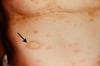 Pityriasis rosé de Gibert (plaque/tache héraldique)