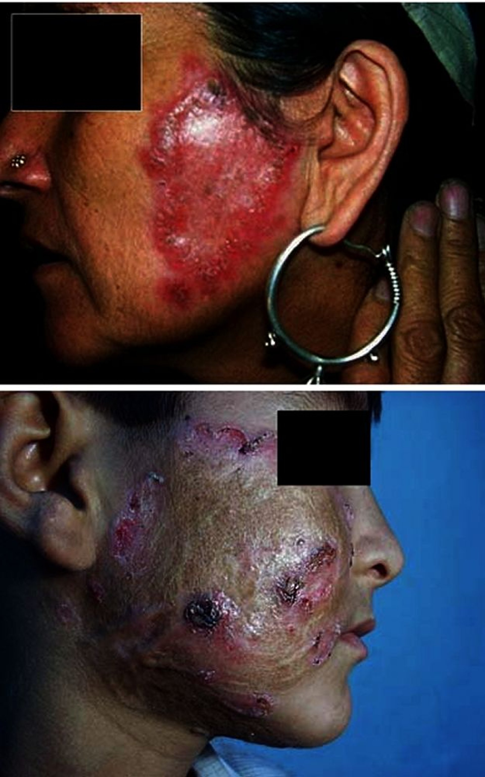 Tuberculosis cutánea (lupus vulgar o lupus vulgaris)