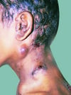 Tuberculosis cutánea (escrofulodermia)