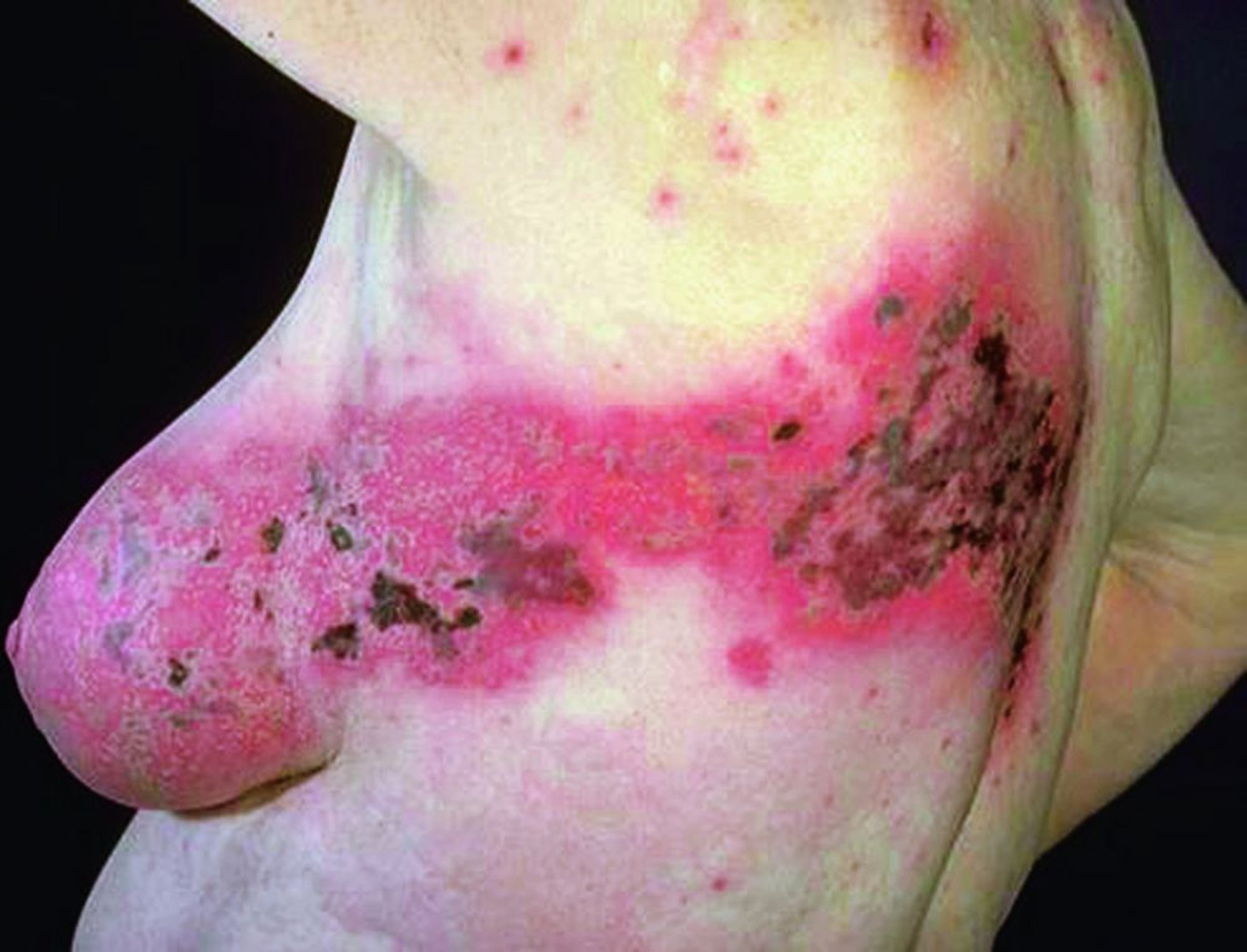 Herpes zóster (dermatoma torácico)
