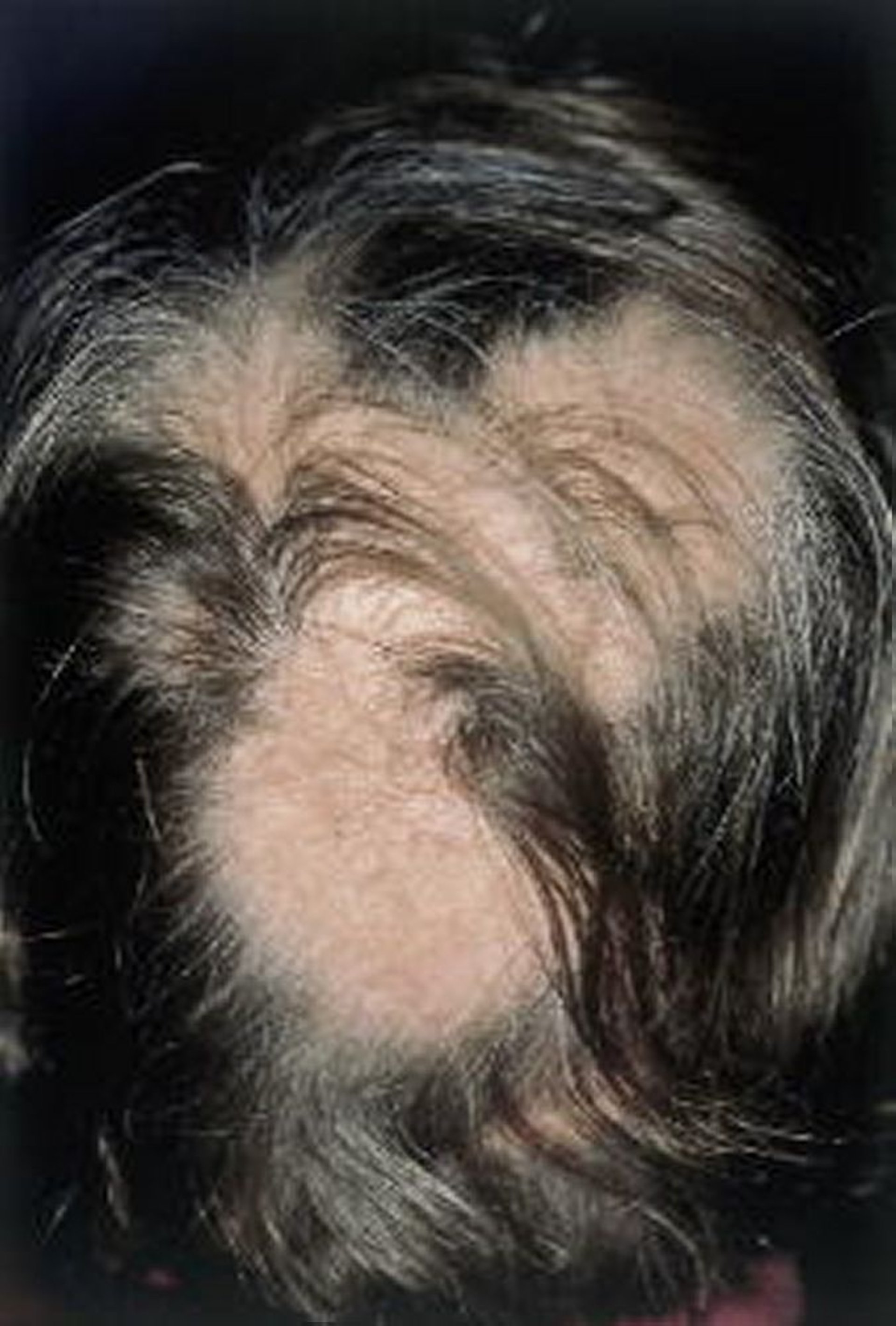 Alopecia Areata