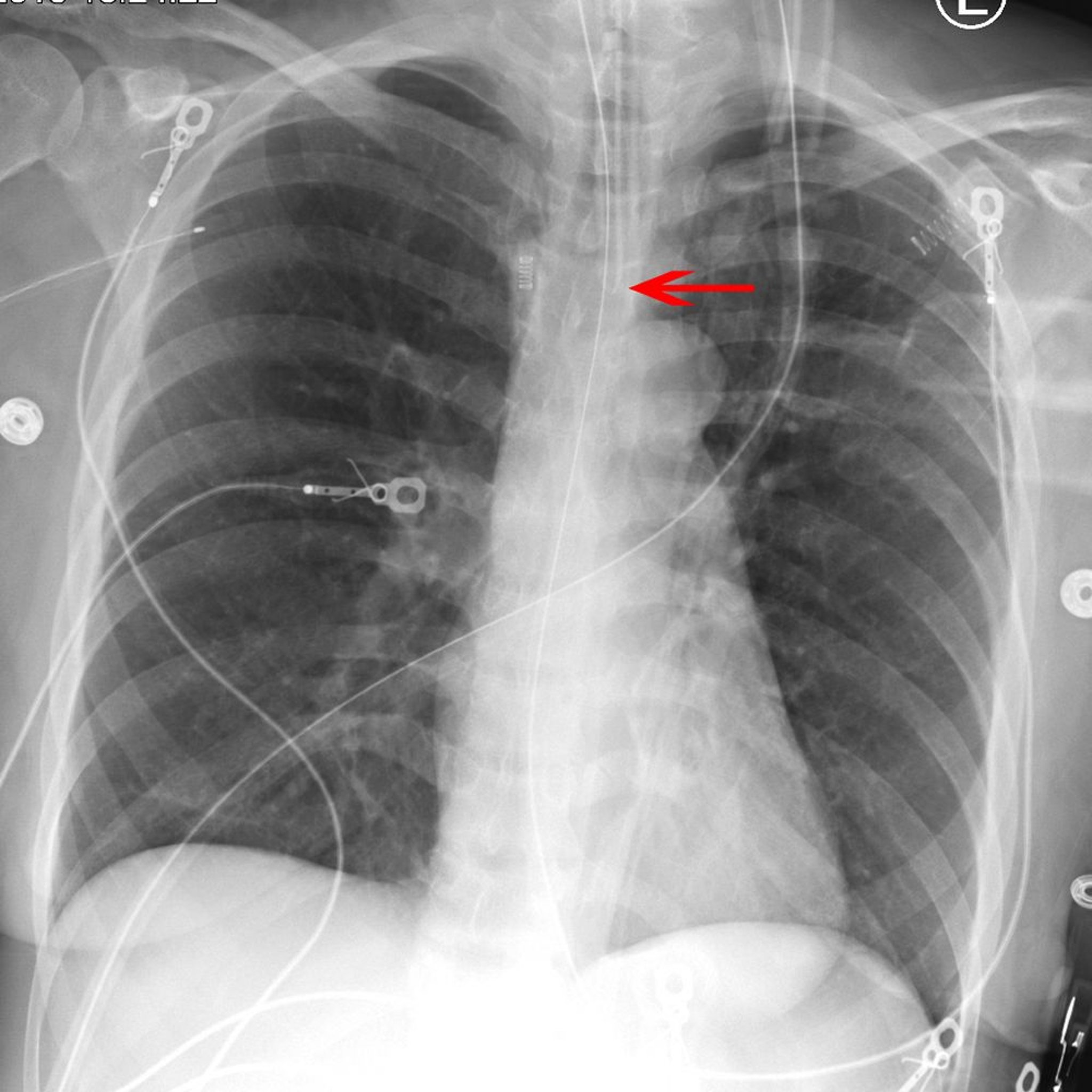 Röntgenbild eines Endotrachealtubus