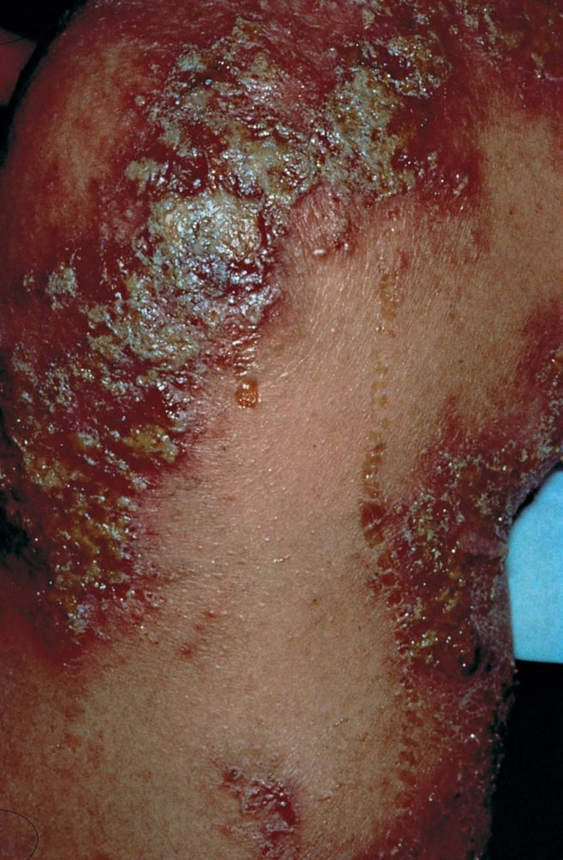 Akute atopische Dermatitis mit Sekundärinfektion