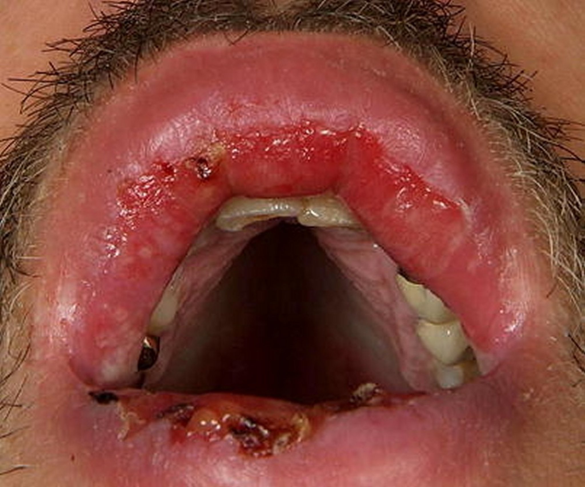 Pemphigus Vulgaris (Oral Mucosa)
