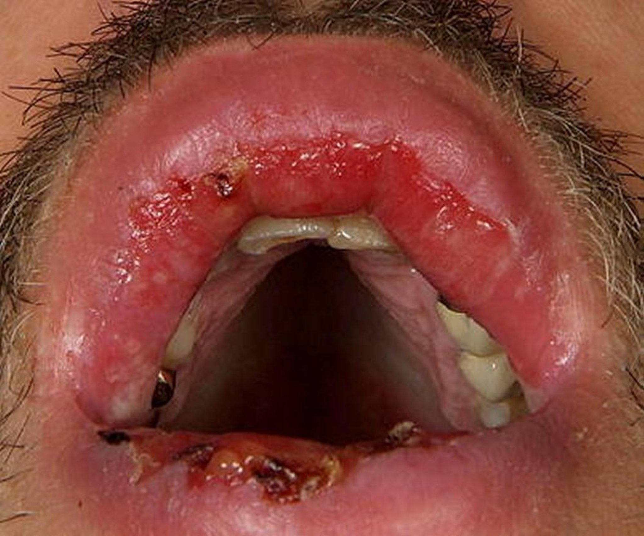 Pemphigus vulgaire (muqueuse buccale)