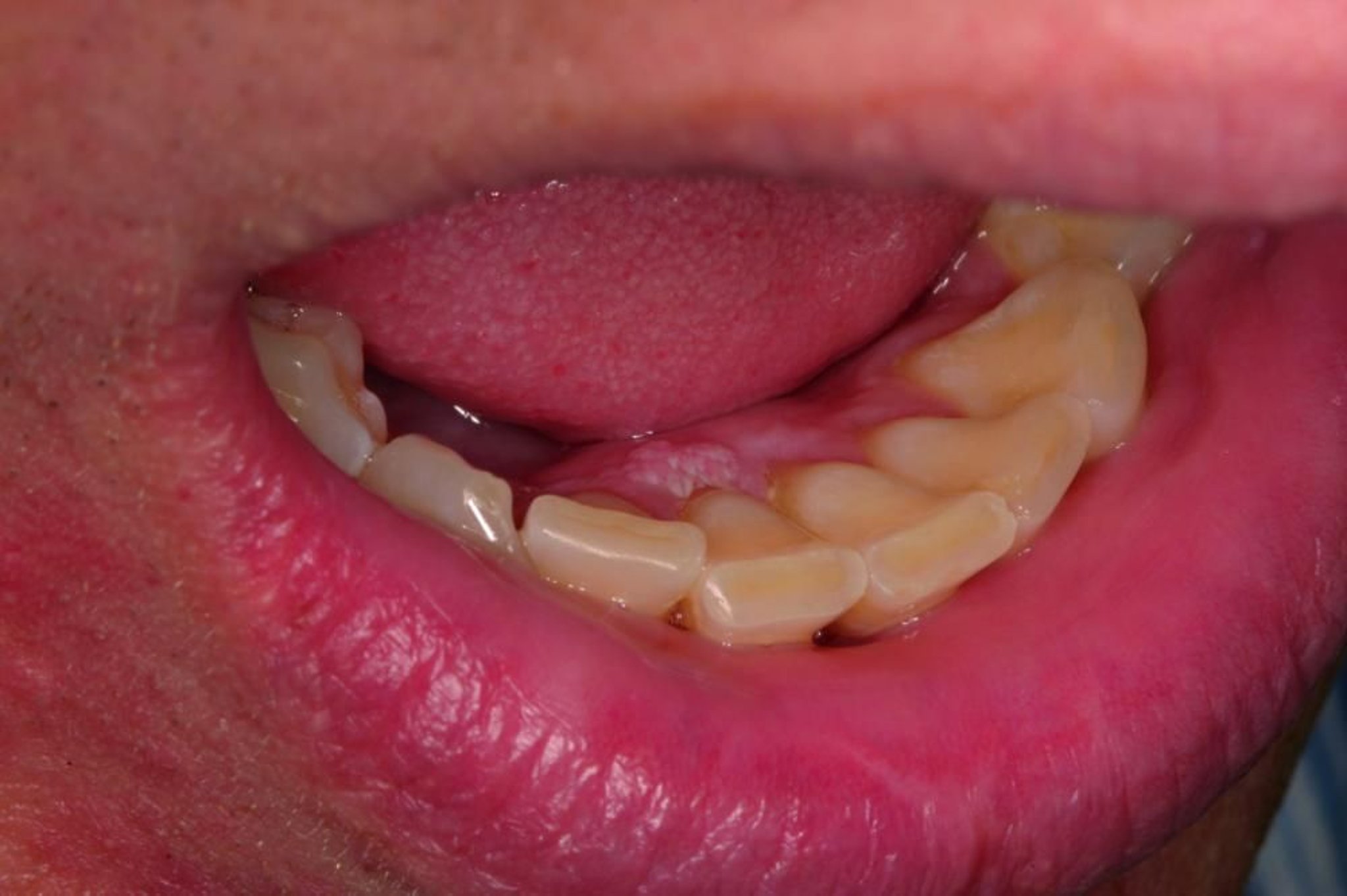 Orale Warzen