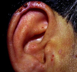 Поздняя кожная порфирия (мочки уха)