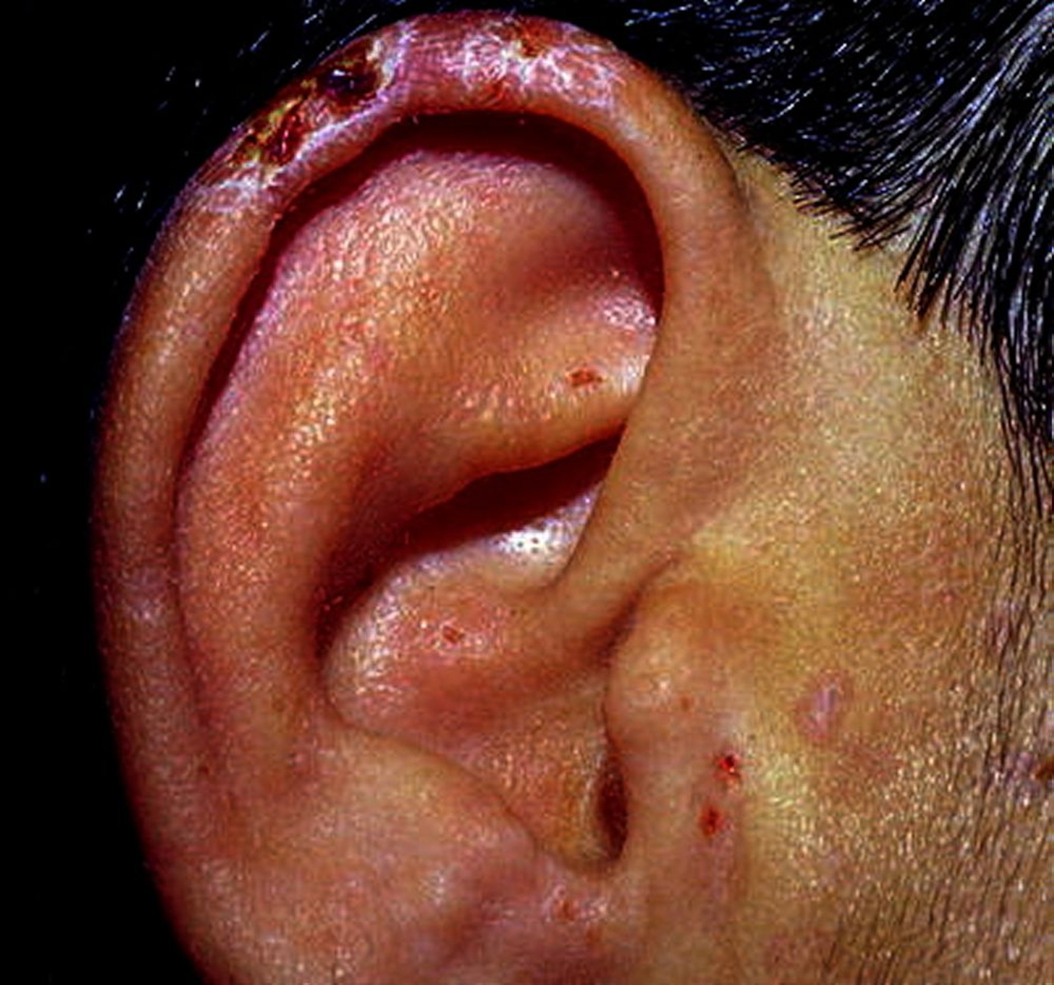 Porphyria Cutanea Tarda (Earlobe)