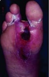 Ulcère du pied