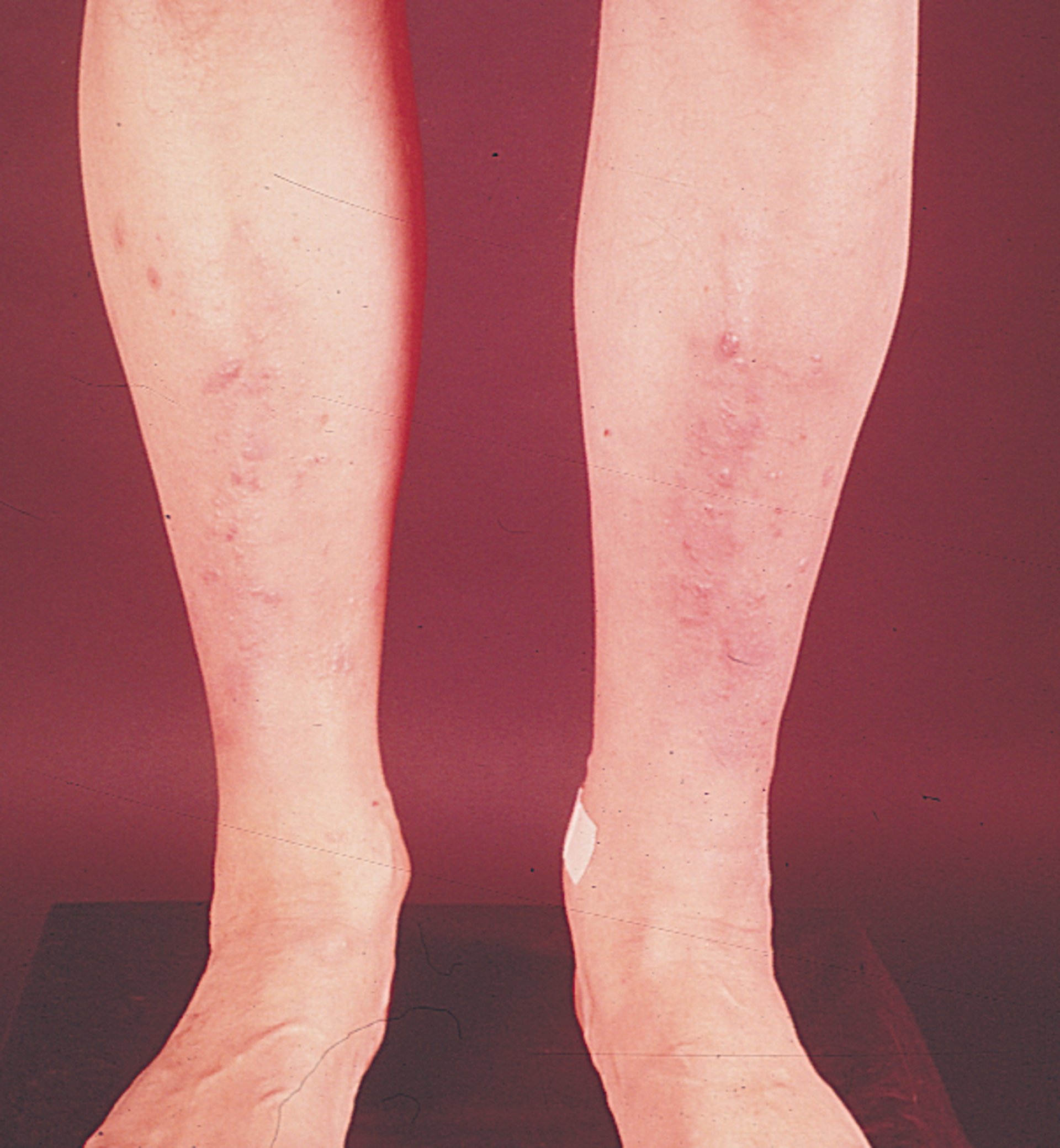 Mixedema pretibial