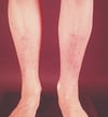 Myxœdème prétibial (léger)