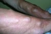 Nhiều u mỡ