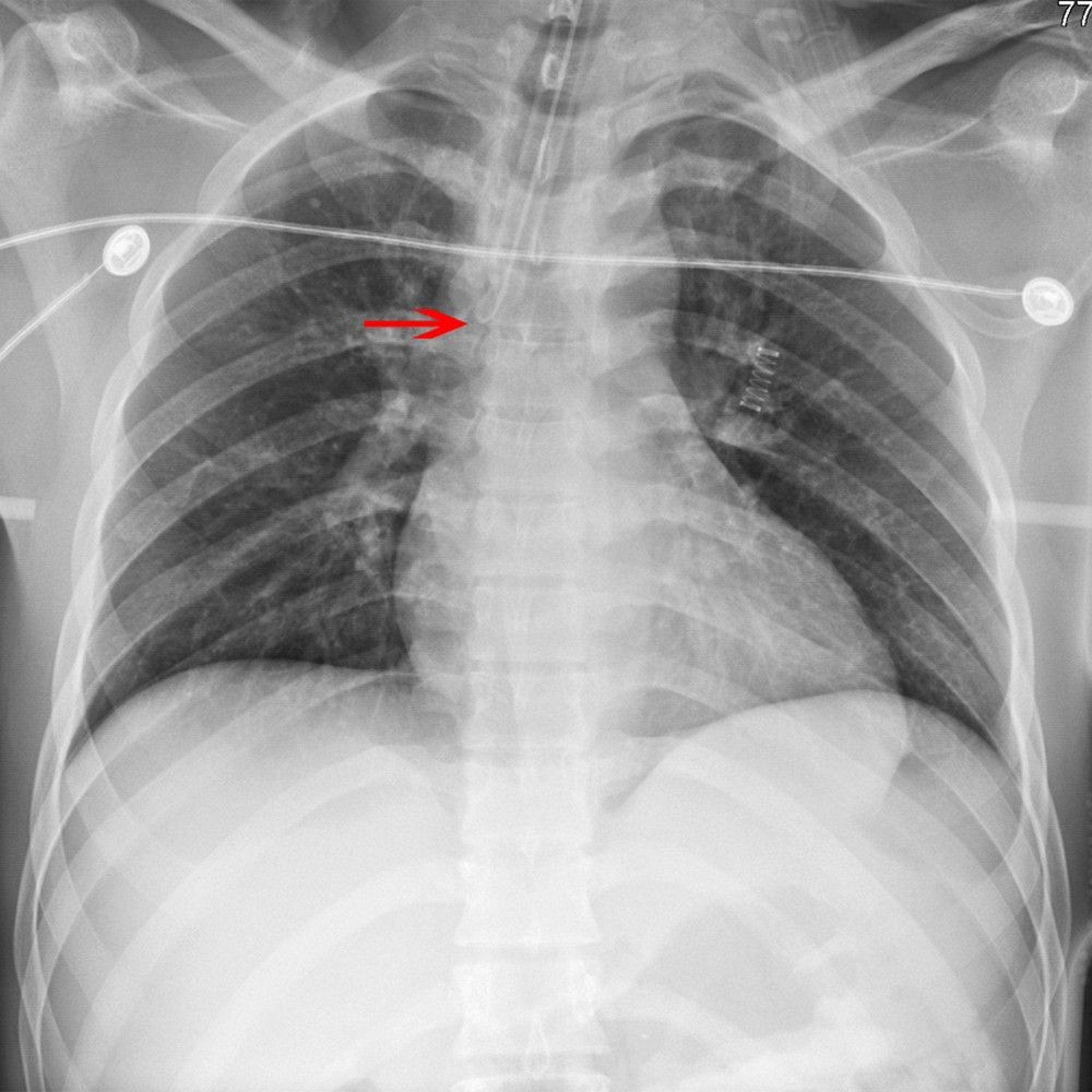 Image:X-Ray of a Misplaced Endotracheal Tube-MSD Manual Professional ...