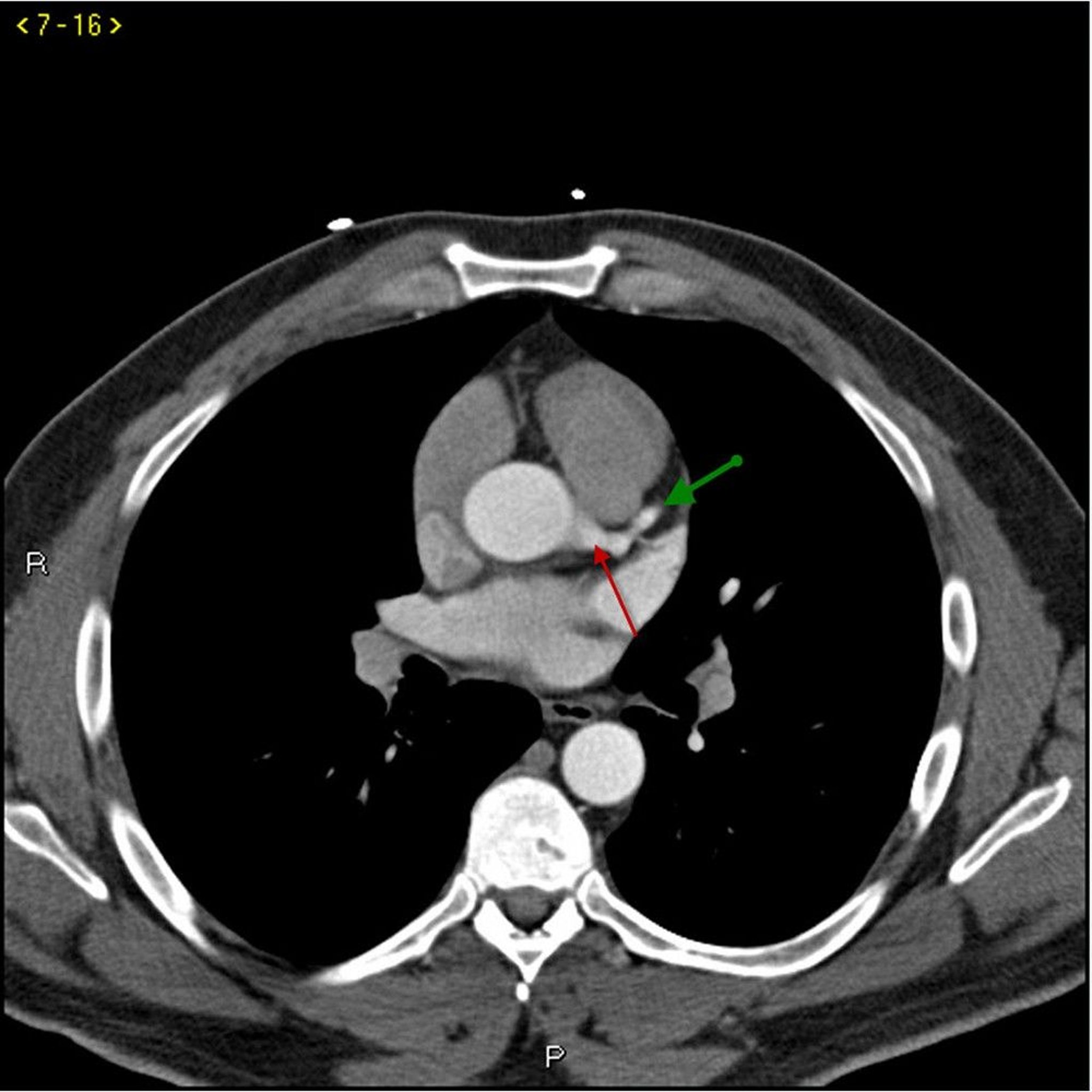 Contrast CT Showing Normal Coronary Arteries – Slide 1