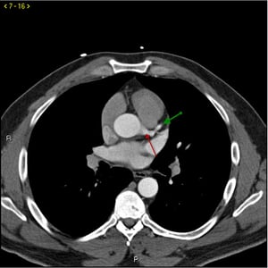 Tomografía computarizada con contraste que muestra arterias coronarias normales–diapositiva 1