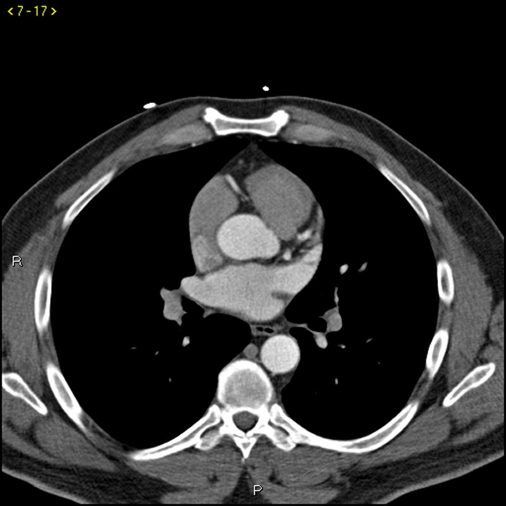 TC con contrasto che mostra arterie coronarie normali, slide 2