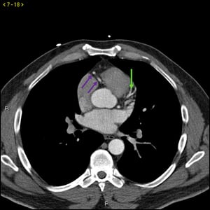 Tomografía computarizada con contraste que muestra arterias coronarias normales–diapositiva 3
