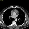TC con contrasto che mostra arterie coronarie normali, slide 3