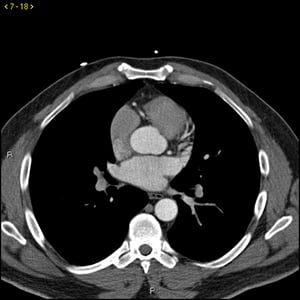 TC con contrasto che mostra arterie coronarie normali, slide 3