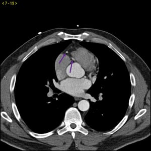 Tomografía computarizada con contraste que muestra arterias coronarias normales–diapositiva 4