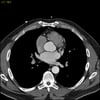 TC con contrasto che mostra arterie coronarie normali, slide 4