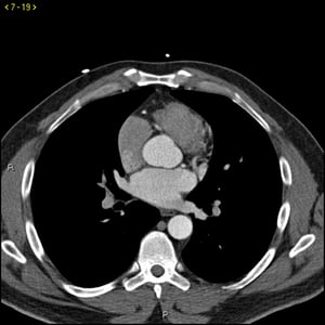 TC con contrasto che mostra arterie coronarie normali, slide 4