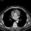 TC con contrasto che mostra arterie coronarie normali, slide 5