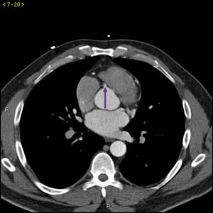 TC com contraste mostrando artérias coronárias normais – Diapositivo 5