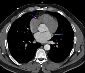 Contrast CT Showing Normal Coronary Arteries – Slide 6