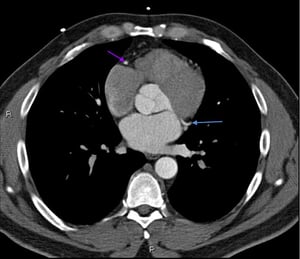Tomografía computarizada con contraste que muestra arterias coronarias normales–diapositiva 6