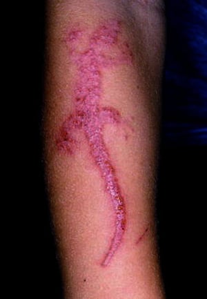 Contact Dermatitis (Tattoo)