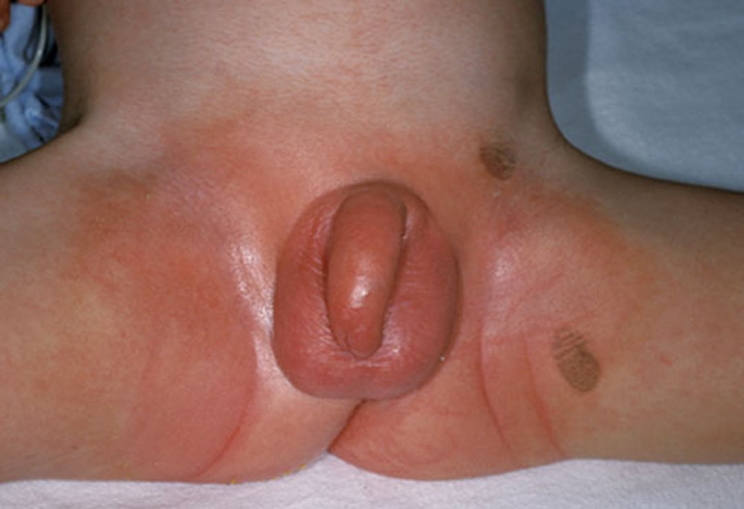 Kawasaki-Krankheit (Exanthem)