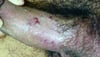 Papulosis bowenoide