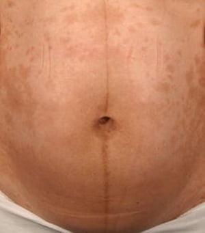 Linea Nigra