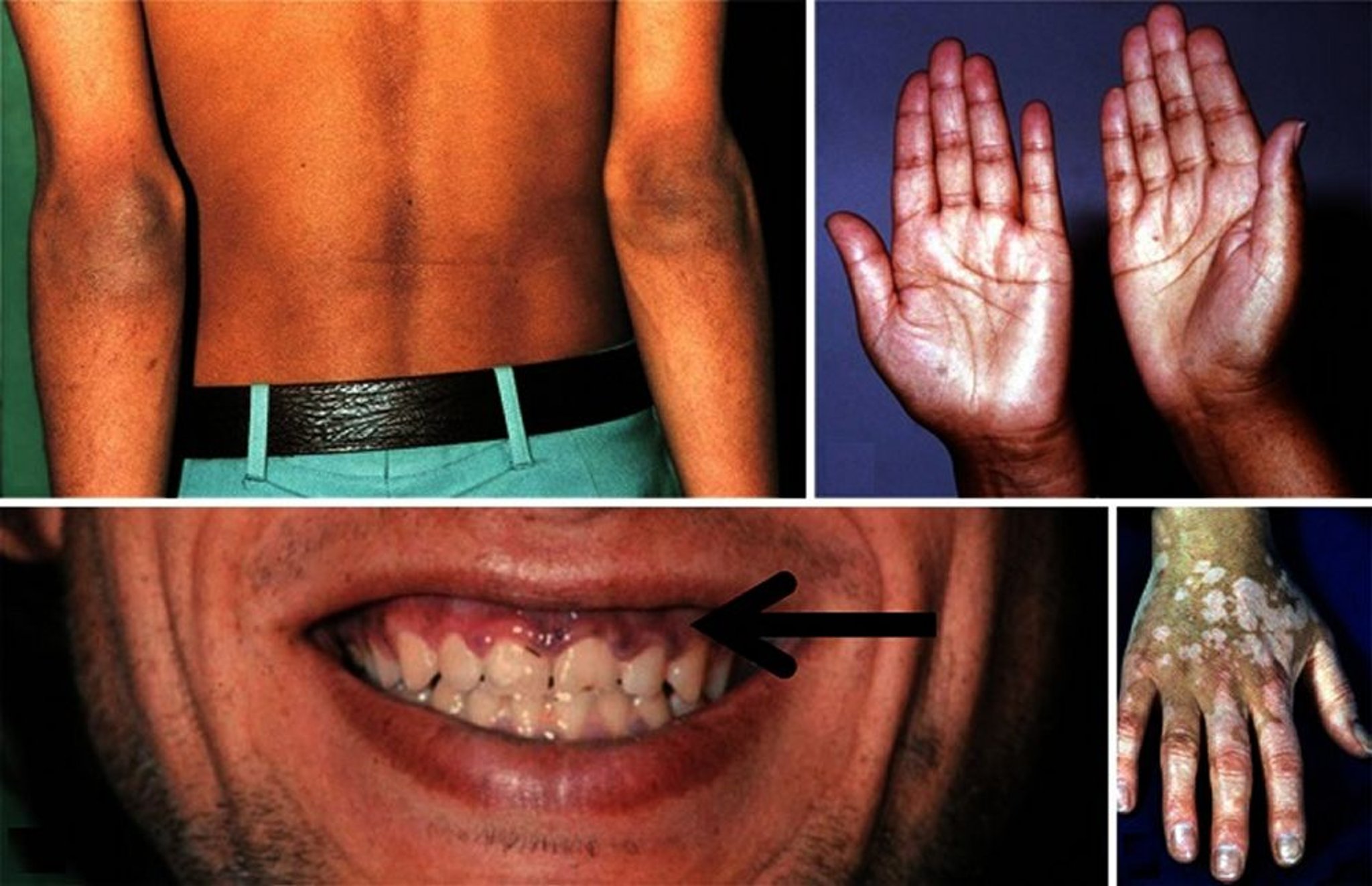 Hyperpigmentation de la maladie d'Addison