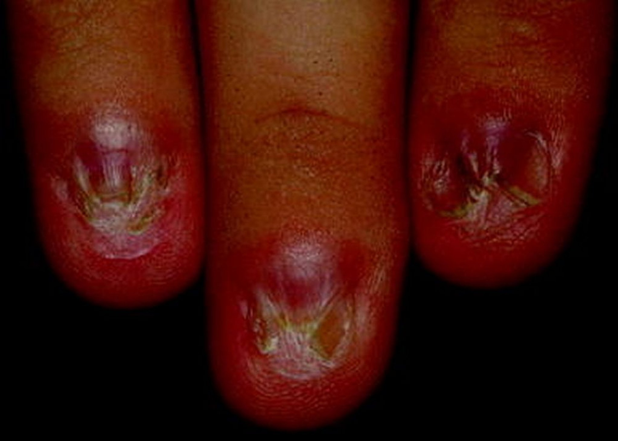 Pterygium des Nagels