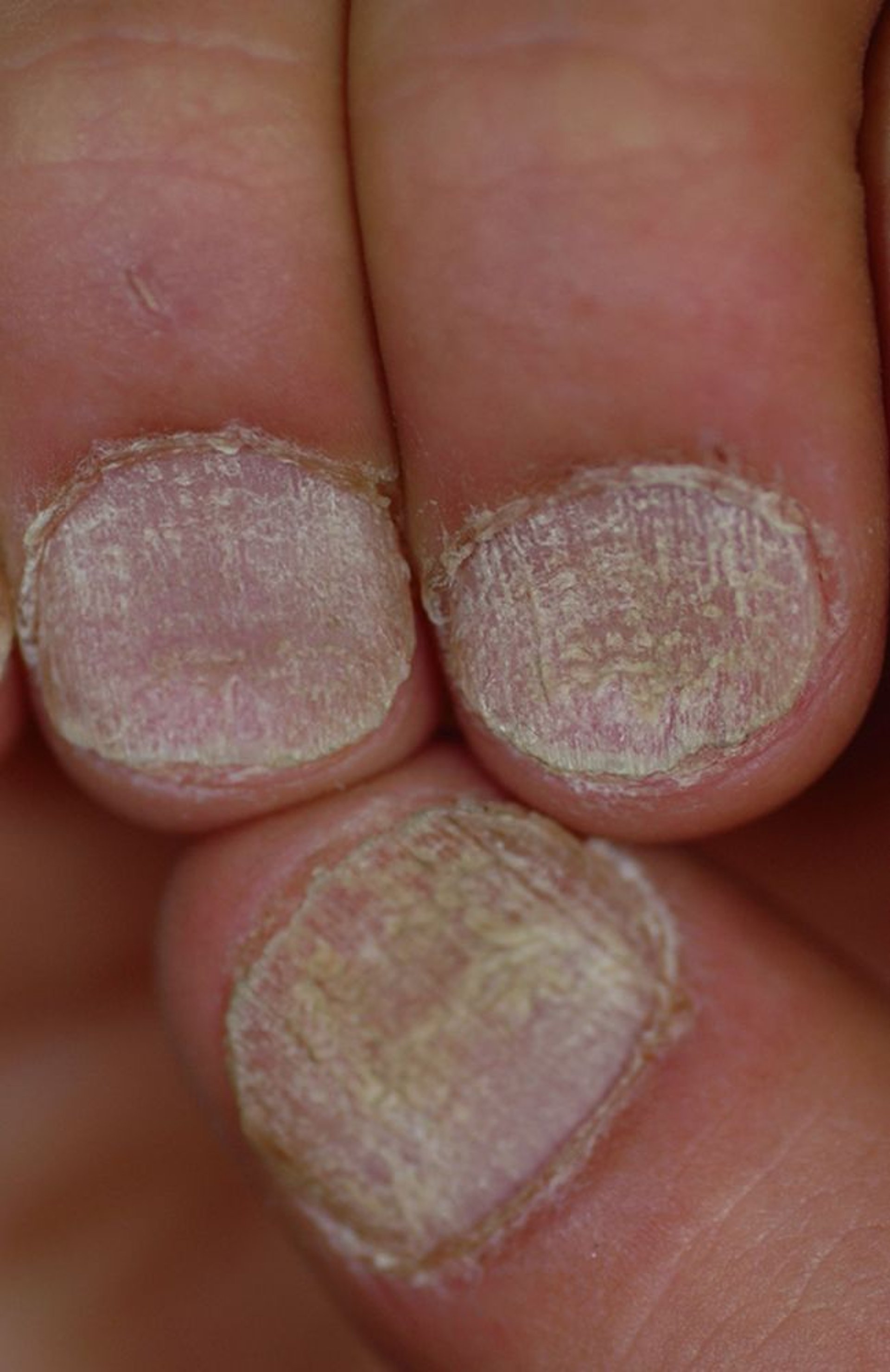 Trachyonychia (móng tay giấy nhám)