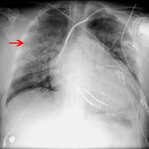 Radiographie d'un patient atteint de syndrome de détresse respiratoire aigu (SDRA)