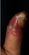 Acrodermatitis Continua von Hallopeau