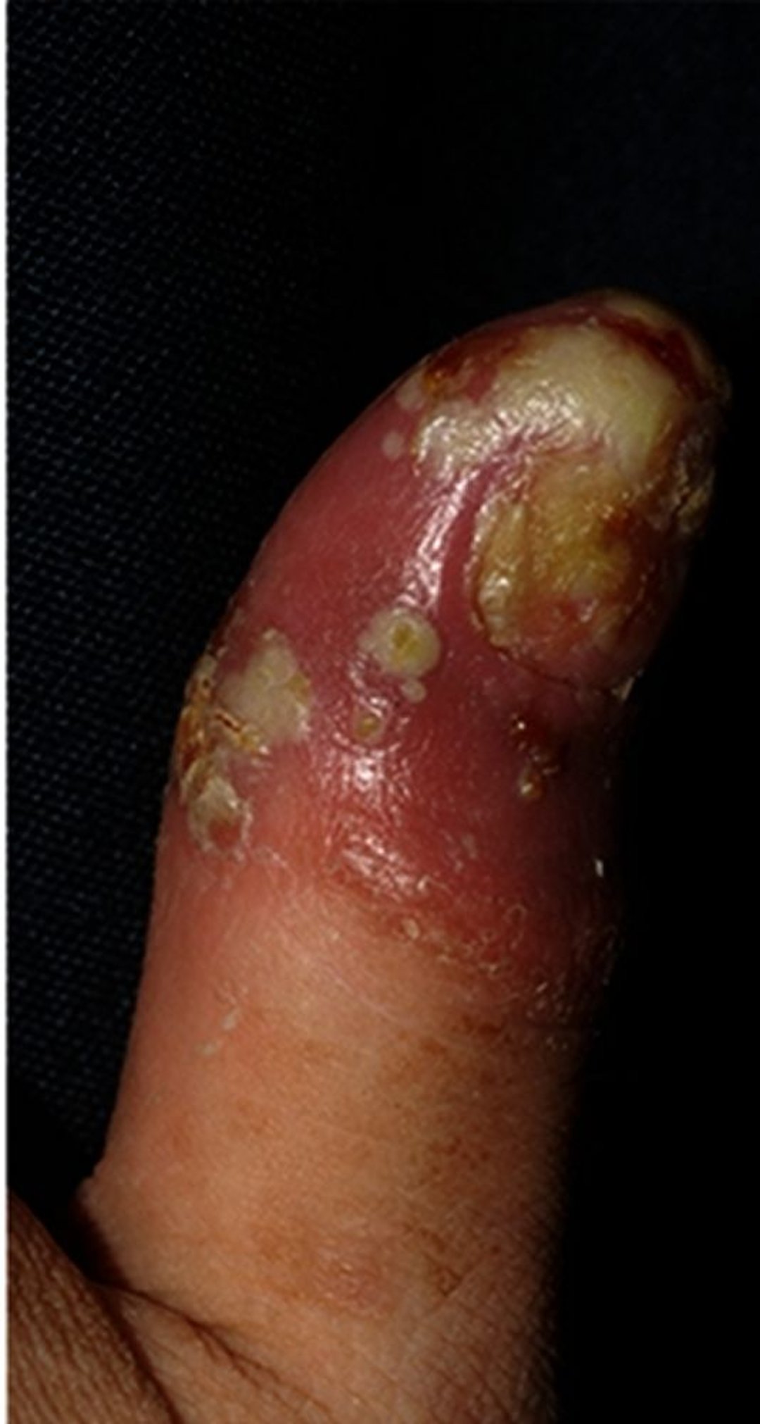 Acrodermatitis continua de Hallopeau